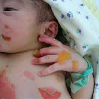 لوگوی کانال تلگرام epidermolysisbullosa — مرض انحلال البشرة الفقاعي
