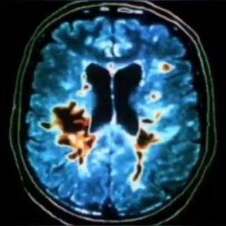 Логотип телеграм канала @msneurol — Рассеянный склероз | Неврология | Медицина | Multiple sclerosis | Neurology | Medicine